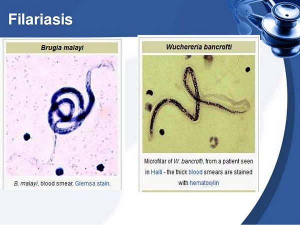 Filariasis (Wuchereria bancrofti y Brugia malayi)
