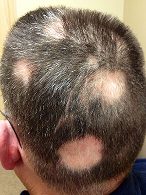 Tiña del cuero cabelludo