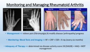 Azulfidine (Sulfasalazina)