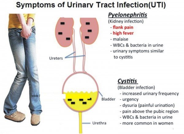 Síntomas de una infección urinaria